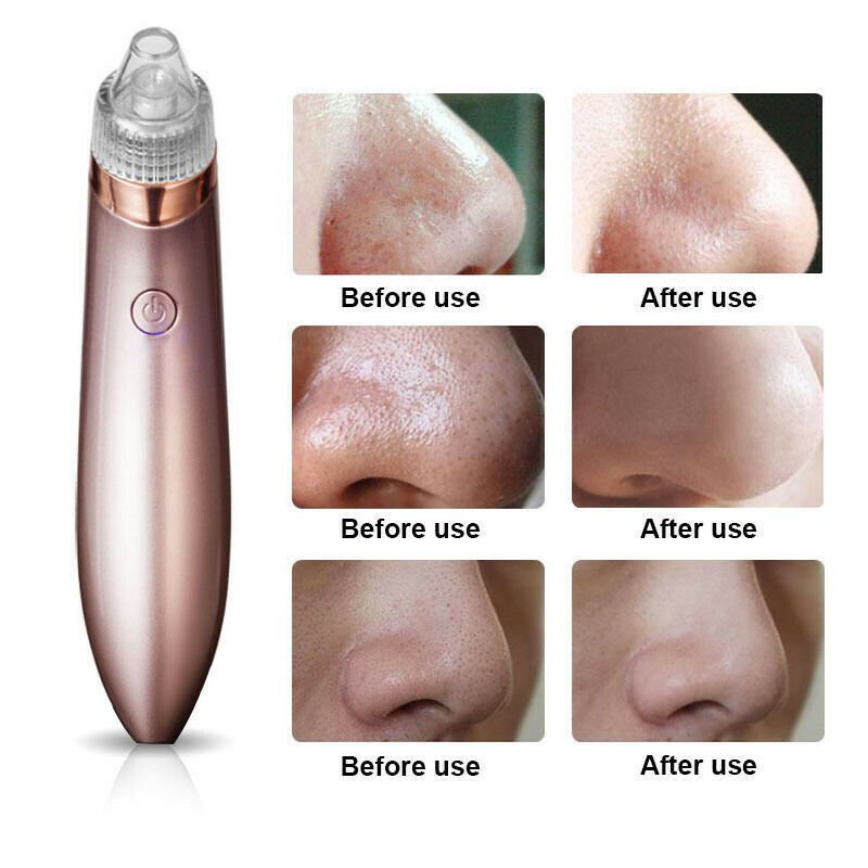 Electric Blackhead Vacuum Remover - Treasure Mementos